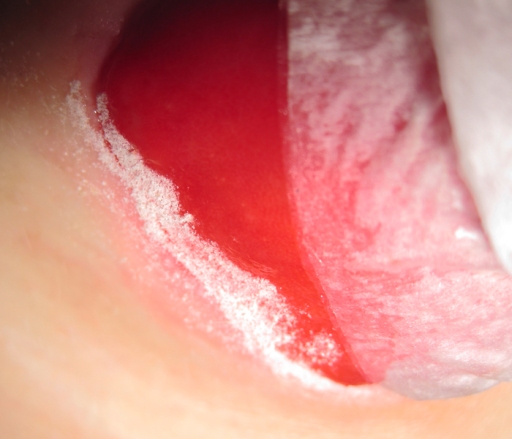 If I develop a sore under my stoma, I put a layer of stoma powder just on the tiny sliver of irritated skin. I then dab the powder with Cavilllon skin prep to form a seal over it. Once dry, I add one more layer of stoma powder followed by one more layer of Cavillon skin prep. This forms a "crust" over the sore that the Duoderm can stick to. The stoma powder also helps heal the sore.