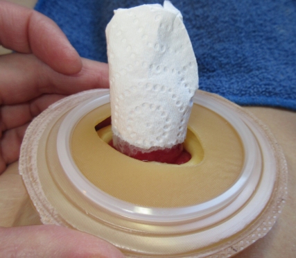 It is easy to slid your wafer right over the stoma when it is wearing a hat. Note that under the wafer, I have already put on my Eakin ring and other materials.